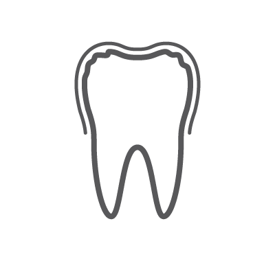 Dental Veneers